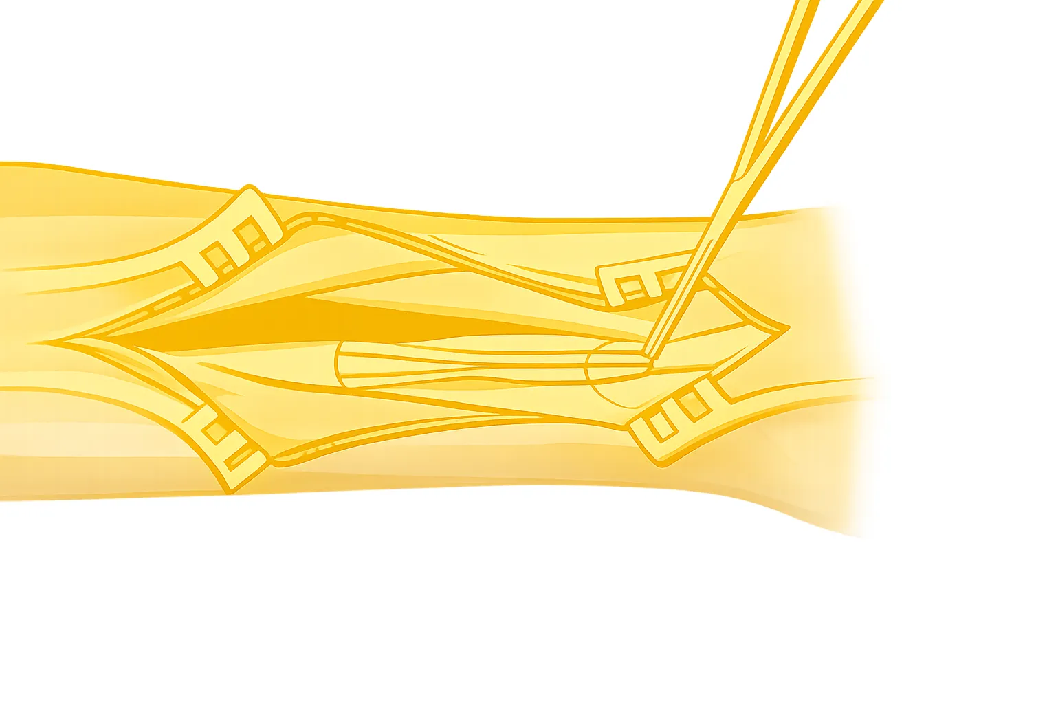 Peripheral Nerve Decompression Surgery